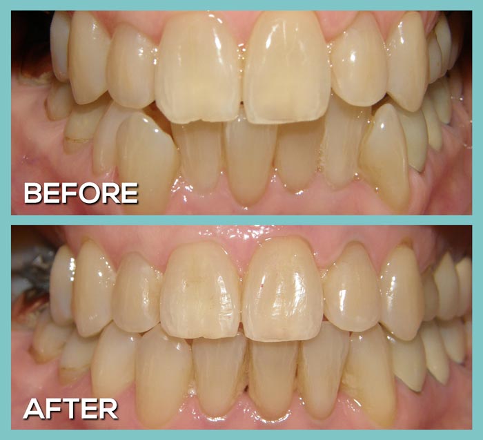 THE TOP TEN REASONS INVISALIGN IS BETTER THAN TRADITIONAL BRACES - Dr. John  Kershman