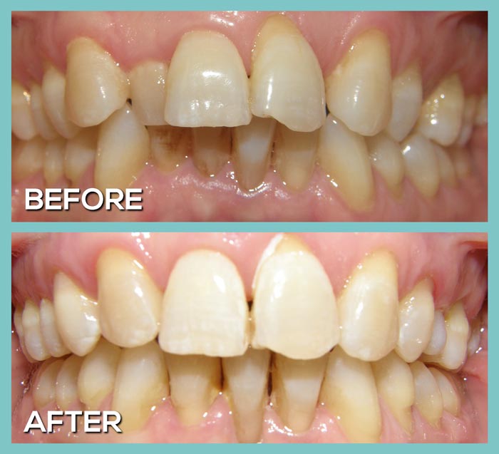 THE TOP TEN REASONS INVISALIGN IS BETTER THAN TRADITIONAL BRACES - Dr. John  Kershman